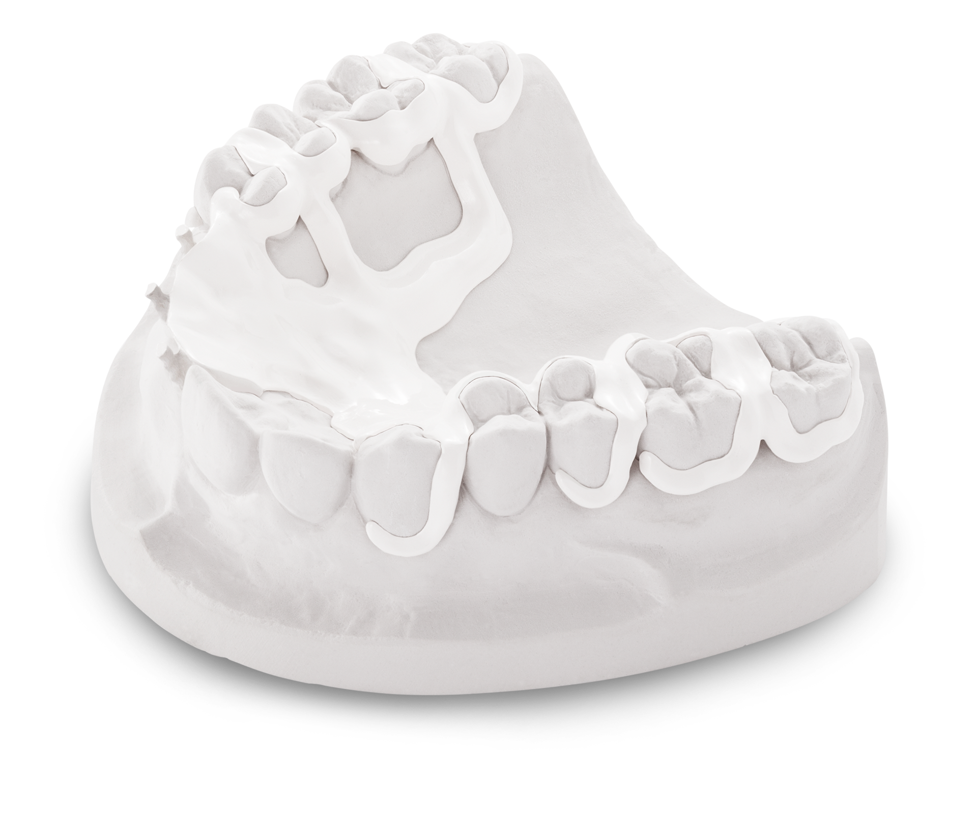 PEEK plastic - the alternative for metal-free dentures