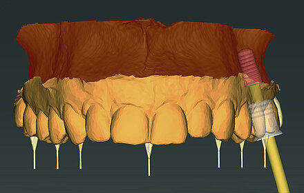3 DIP - 3 Dimensionales Planungssystem für Implantate