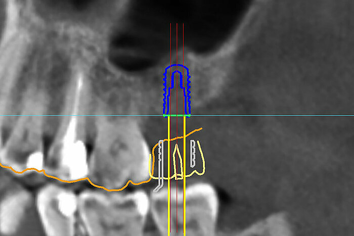 3 DIP - 3 Dimensionales Planungssystem für Implantate