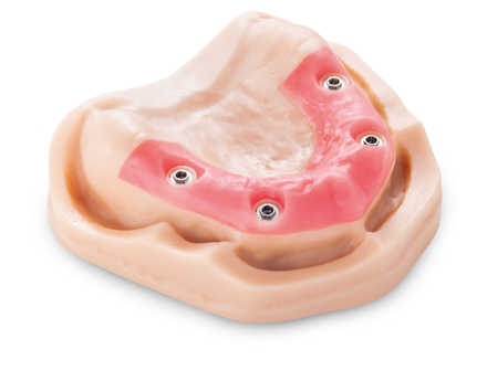 Implantat Modell im 3D-Druck