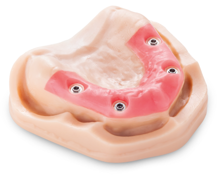 Implantat Modell im 3D-Druck