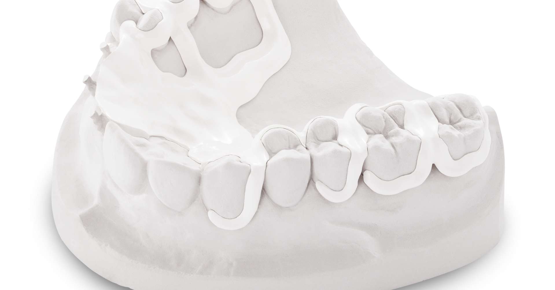 PEEK plastics Alternative for metalfree dentures