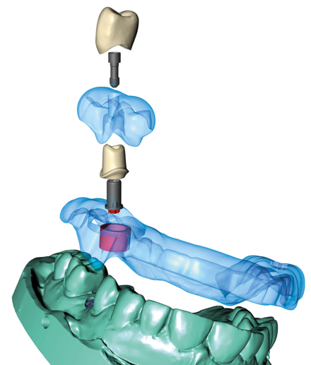 3DIP in der dentalen Implantologie